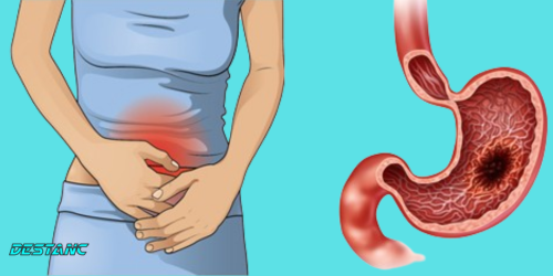 Stomach cancer is a silent killer: here are the signs and symptoms
