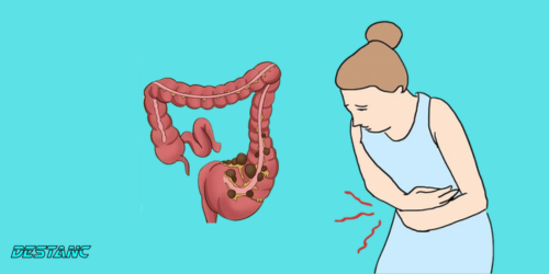 Unusual signs of colon cancer that women often ignore